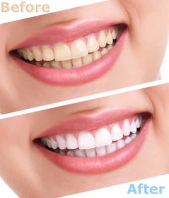 Repairing Tooth Enamel | Amherst Cosmetic Dentist | Douglas Hamill DDS