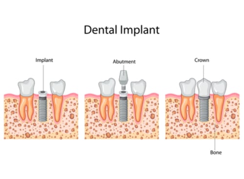 Dental Implants in Buffalo, NY | Free Consultation | Douglas Hamill DDS