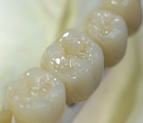 Dental Caps | Buffalo Dentist | Dental Crowns | Affordable Dental Crowns