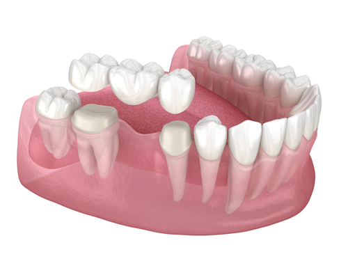 Types of Dental Bridges in Buffalo, NY | Tooth Loss | New Teeth