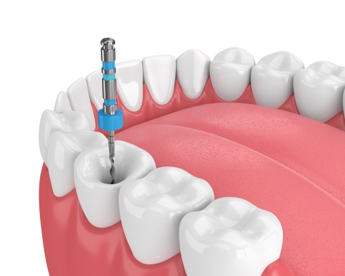 Root Canal Treatment in Buffalo, NY Douglas Hamill DDS