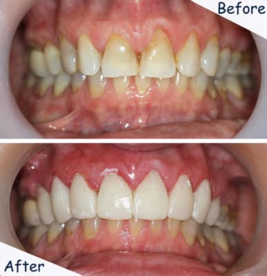 Amherst Dental Bonding Treatment Amherst Dentist Free Consultations