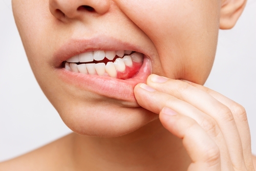 Gum Problems in Buffalo, NY | Bleeding Gums | Teeth Cleanings