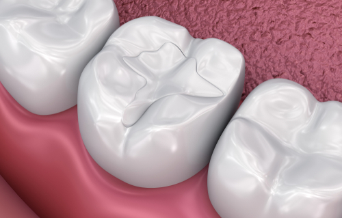 Dental Fillings in Buffalo, NY | Cavities | Book a Free Consultation