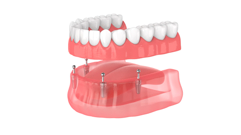 Dentures-in-Amherst-NY-Dr.-Samantha-Smith