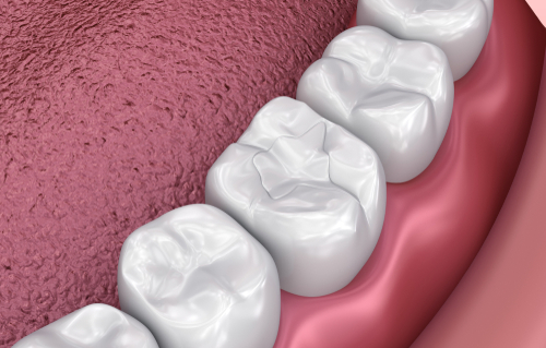 Dental Filling in Amherst, NY | Restorative Dentistry Solutions