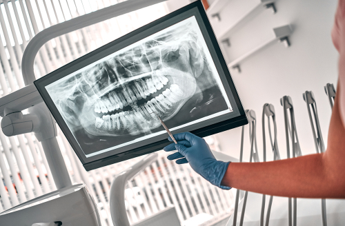 Tooth Extraction in Amherst, NY | Relieve Pain & Protect Your Smile