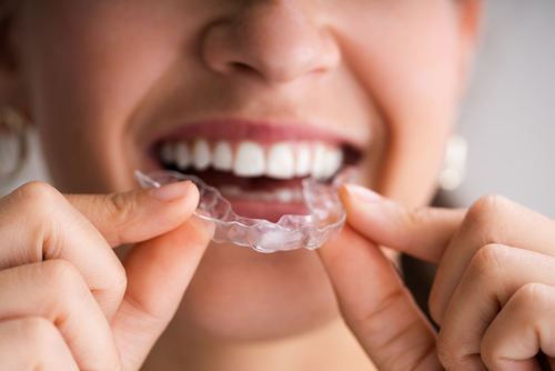 Invisalign Treatment | Affordable Clear Aligners in Buffalo, NY