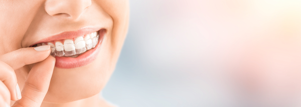 Invisalign in Buffalo, NY