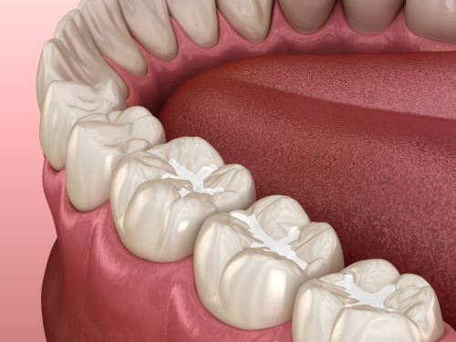 White Fillings in Buffalo, NY | Treat Decay Without a Metallic Look