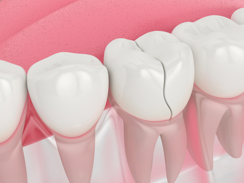 Cracked Tooth Treatment | Emergency Dental Care in Amherst, NY