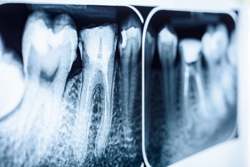 Dental Extraction | Affordable Dental Care in Amherst, NY