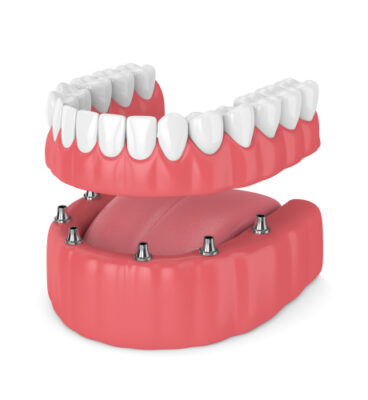 Snap-On Dentures in Amherst, NY | Implant Dentist Near Me