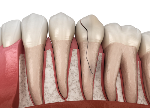 Chipped Tooth Repair in Amherst, NY | Affordable Care Near Me