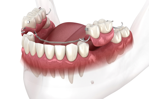 Dental Bridges vs. Partial Dentures | Payment Plans in Amherst